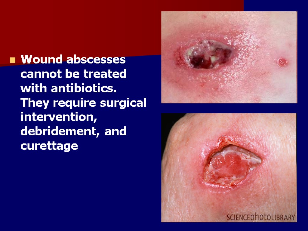 Wound abscesses cannot be treated with antibiotics. They require surgical intervention, debridement, and curettage